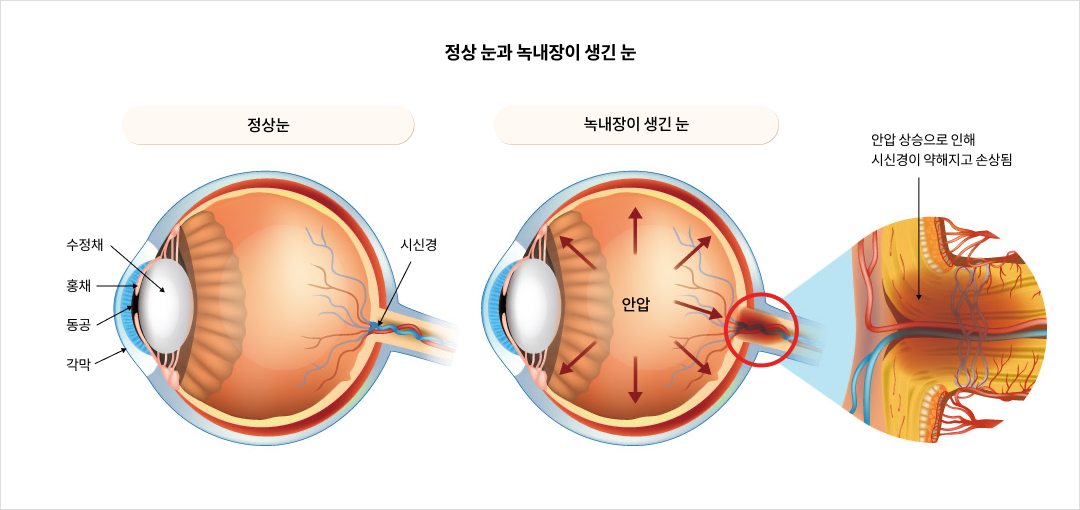 정상 눈과 녹내장이 생긴 눈