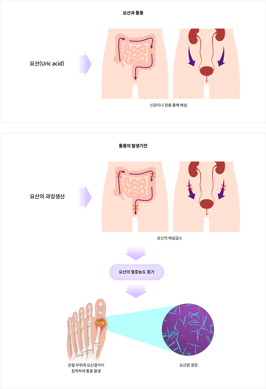 mgz_gout_img1_pc.png 요산과 통풍