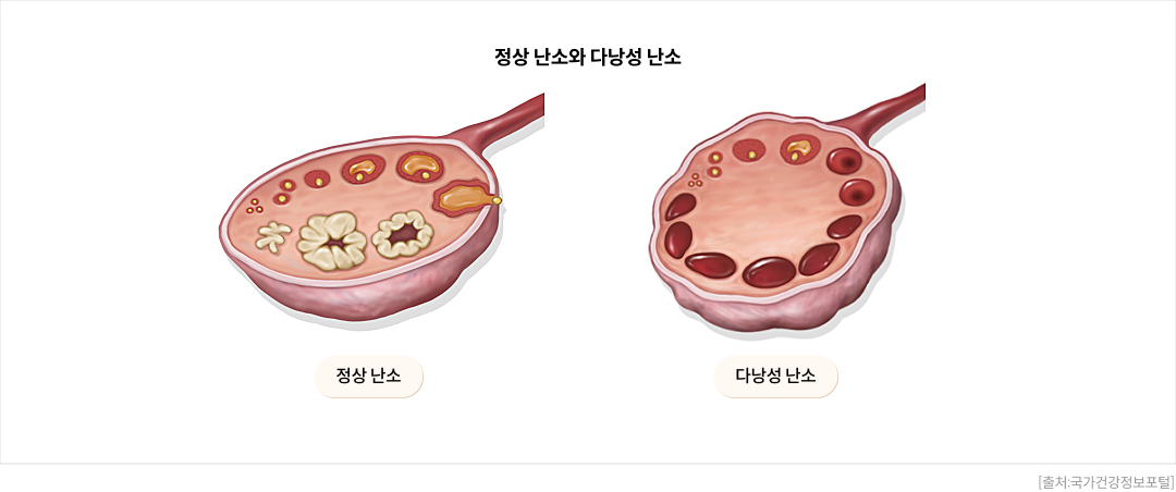 mgz_pcos_img1_pc.png 정상 난소와 다낭성 난소