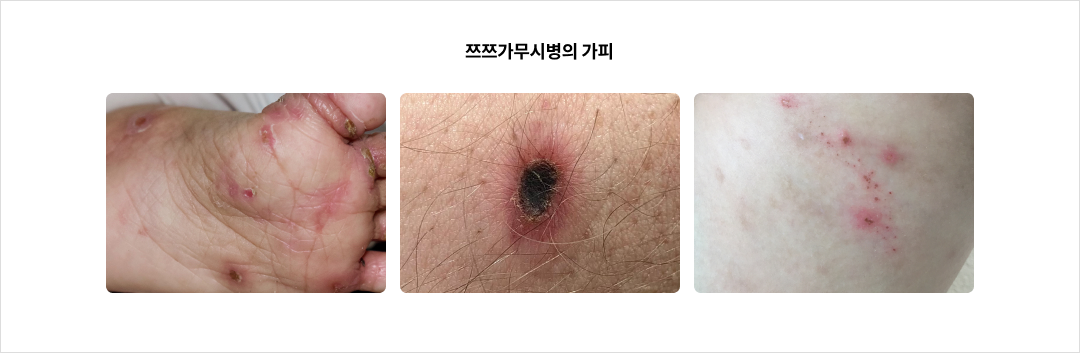 쯔쯔가무시병의 가피